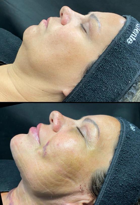 Antes e depois, Case 02, Juliana, 41 anos